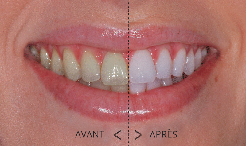 Dents plus blanches – jusqu’à 5 tonalités  avant et après
